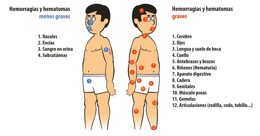 Sintomas del reuma en la sangre